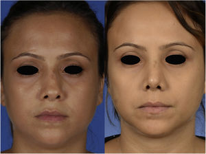 Frontal view of the patient, preoperatively (left) and 1 month postoperatively (right).