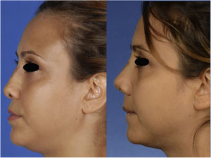 Lateral view of the patient, preoperatively (left) and 1 month postoperatively (right).