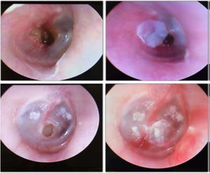 Patients’ otoscopy procedures: on the left showing the perforation and on the right, after the cellulose film placement.