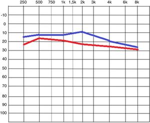 Tonal audiometry image, comparing the means of the initial values in red, and after the film placement, in blue.