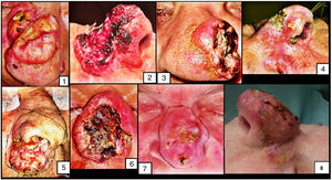 Clinical images of the first eight cases submitted to total rhinectomy.