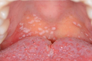Hyperplasia of the fungiform papillae (arrows), with an edematous and erythematous appearance, characterizing a transient lingual papillitis.