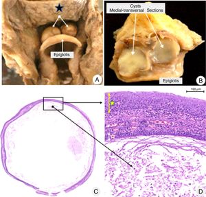 (A) Bilateral vallecular cysts (white arrows), located between the base of the tongue (blue star) and epiglottis. (B) Transversal sections of both cysts with similar macro and microscopic aspects: thin walls and filled with a mucinous yellow-tan material. (C) Panoramic microscopic section from the right cyst: thin membranous-like wall, partially filled with cellular debris and amorphous secretion (hematoxylin–eosin staining). (D) High power magnification of the demarcated area in (C). Both sides of the cysts (the outer surface indicated by a yellow star, and the inner surface by a red star) are lined by stratified, non-keratinized epithelia. The walls of both cysts are thin, delicate, composed by fibrous soft tissue, small vessels, and scarce lymphoplasmacytic infiltrate (HE staining).