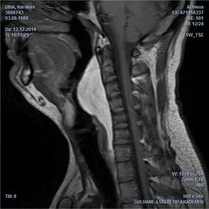 Sagittal T1-weighted MRI depicts the hyperintense retropharyngeal mass lesion similar to fat.