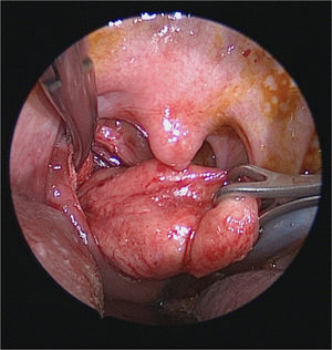 Dissection of the mass in the retropharyngeal space.