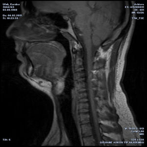 Postoperative sagittal T1-weighted MRI showed that the mass was totally resected.