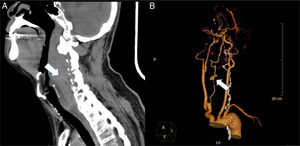 Contrast-enhanced computed tomography scan of the neck showing (A) the retropharyngeal hematoma extending from the base of the skull to the C7 level and syndesmophytes of the spine and (B) the pseudo-aneurysm formation on the right vertebral artery.