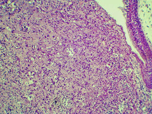 Undifferentiated high-grade pleomorphic sarcoma arising in larynx: A pleomorphic malignante neoplasia exhibiting epithelioid cells with marked nuclear and cellular atypia, Hematoxylin-eosin, 100×.