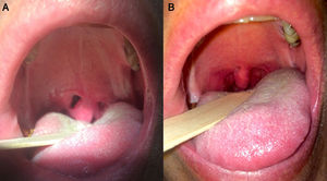 The palatal fistula is demonstrated in (A) and the healed fistula is demonstrated in (B).