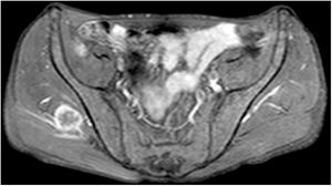 MRI evidence of right gluteus medius muscle metastasis.