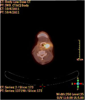 A PET-CT image showing a dense hypermetabolic involvement in larynx. Appearance of locoregional recurrence following partial laryngectomy.