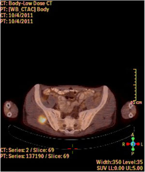 Gluteus medius metastasis from laryngeal SCC. A PET-CT image showing a dense FDG accumulation in right gluteus medius.