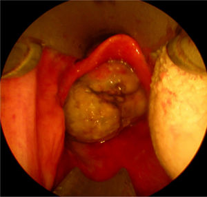 Endoscopic visualization of the laryngeal mass via Weerda diverticuloscope with the patient in supine position. The epiglottis appears completely normal above the intralaryngeal tumor mass.