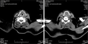 Axial computed tomography (CT) at the level of the thyroid (left) and cricoid (right) cartilages with complete lumen obstruction and no evidence cartilage invasion. The patient breathes through a tracheostomy.
