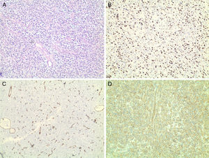 Histology images of hemangiopericytoma with different stains: (A) hematoxylin–eosin; (B) immunohistochemical stain for Ki-67; (C) immunohistochemical stain for CD34; (D) immunohistochemical stain for CD99.