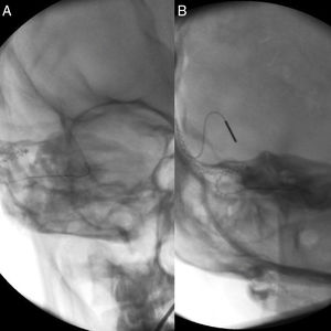 (A) Fluoroscopy after first insertion (tip rollover); (B) fluoroscopy after second insertion (correct placement).