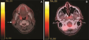 PET-CT with intravenous injection of f-18 Fludeoxyglucose (FDG). (A) White arrow – right sided parotid mass enhancement. (B) White arrow nasopharyngeal enhancement.