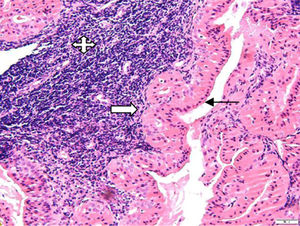 Histologic examination revealed papillary and cystic lesions comprised of epithelial and lymphoid cells (H&E stain, 200×). The epithelial component shows a double layer of granular eosinophilic/oncocytic cells: luminal non-ciliated columnar cells with nuclei aligned toward the lumen (black arrow) and basal round or polygonal basal cells having vesicular nuclei (white arrow). The lymphoid component was composed of mature small lymphocytes (quad arrow) (Image 7883, H&E stain, 200×).