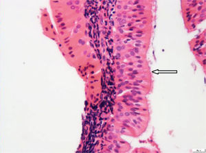 Nasopharyngeal lining columnar ciliated epithelium (white arrow) is not involved (H&E stain, 400×).
