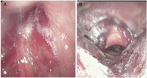 An extensive submucosal hemorrhage. (A) The nasopharynx; (B) the larynx and hypopharynx.