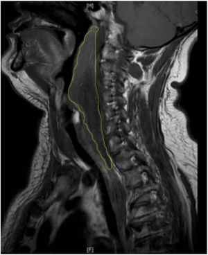 Sagittal magnetic resonance imagery revealed an abnormal irregular signal extending from the second cervical vertebra to the posterior mediastinum.