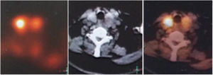 Single-photon emission computed tomography scans revealed a left-side parathyroid gland adenoma.