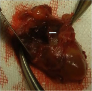 A clot within the tumor capsule.