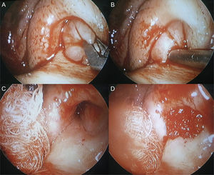 Intraoperative findings. (A and B) The mass rised from the pharyngeal orifice of the Eustachian tube and extended to the nasopharynx. (C and D) After complete removal via endoscopic approach, Gelfoam® was soaked in dexamethasone and gentamycin and inserted in orifice where there was a stalk of the mass.