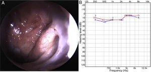 Postoperative findings. (A) Nasopharyngoscopy showed that the mass was removed and the Eustachian tube orifice remained wide open. (B) Pure tone audiogram showed that the hearing of left ear was normalized and air-bone gap was disappeared.