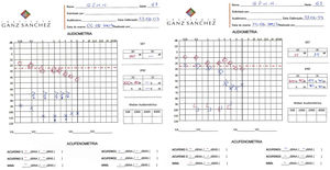 Patient's first audiometry (left) after perceiving sudden hearing loss and tinnitus (May, 2007) and second audiometry (right) after treatment, with partial improvement of hearing loss and tinnitus (June, 2007).