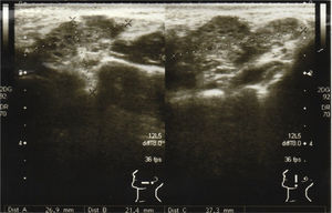 Ultrasound of left cheek showed a mass of 26.9×21.4×37.3mm.