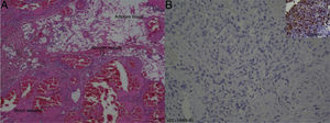 (A) Histological examination showed presence of mature adipose tissue, smooth muscle and thick walled blood vessels component (haematoxylin and eosin, original magnification 20×); (B) immunohistochemistry examination of smooth muscle with HMB-45 showed negative result, compared to the control over right upper corner (original magnification 20×).