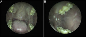(A) The oral cavity 1 month after excision; (B) the left buccal mucosa 1 month after excision.