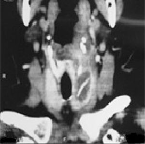 CT showed juxtaposed collection on the left thyroid lobe with a foreign body inside.