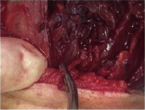 Foreign body adjacent to the trachea, lying 2mm from the usual path of the ipsilateral recurrent laryngeal nerve.