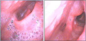 Laryngeal fiberscope at admission. Epiglottis and left arytenoid mucosa are edematous.