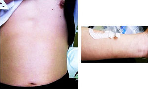 Erythematous rash at abdomen and extremities.