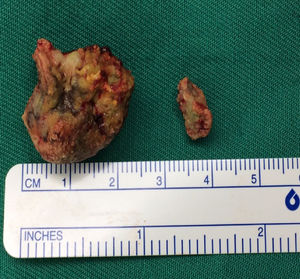 The larger round stone originated from the right peritonsillar space while the smaller oval stone was found at the upper pole of right tonsil.