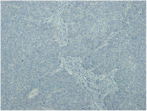Non-metastatic squamous cell carcinoma; negative CSE1L staining.