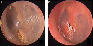 The pseudo healing of traumatic TMP and EGF treatment: the pseudo healing of eardrum within 2 months after perforation, thickened tawny tissue and a punctate perforation were seen (a); 10 days after EGF treatment (b).
