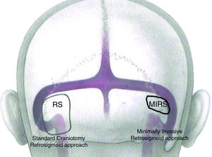 Difference in dimension of a craniotomy performed with a traditional retro-sigmoid approach and with the EAMIRSA.