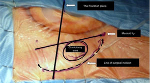 The image shows the area where the minimally invasive craniotomy is performed with the landmark. Image from Ricci GP, Di Stadio A et al. ''Endoscope-assisted retrosigmoid approach in hemifacial spasm: an orl experience''.