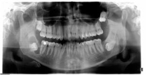 Panoramic radiograph showing cystic area around the unerupted teeth in three quadrants.