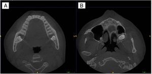 CBCT axial scans (A and B) showing bucco-lingual expansion and the cortical thinning in the mandible involving the third molars (A) and the upper left third molar (B).