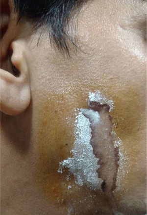 After sprinkling with starch flour and giving sialogogue, the site of salivary leak is seen.