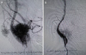 (A) Angiography before coil embolization. (B) Angiography after coil embolization.