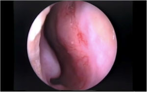 The little area (Kiesselbach's plexus): anterior to the nasal septum.