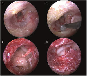Photographs showing (a) the regeneration of the perforation edges; (b) the transcanal simultaneous incision and cauterization via insulated Rosen blades; (c) an inspection of the middle ear structures; (d) an intra-operative view of the perforation after chondroperichondiral grafting.