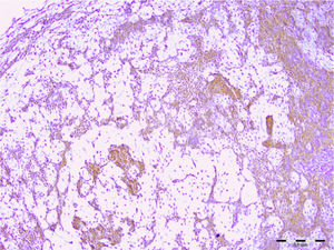 Immunohistochemical expression of syndecan-1 in pleomorphic adenoma (scale bar represents 0.2mm).