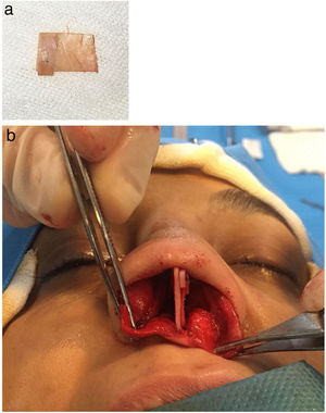 (a) Prefabricated caudal extension graft made by suturing a bar graft on it; (b) The bar graft is placed on the left side of the caudal septum and fixed in the empty space between the septum and caudal graft.